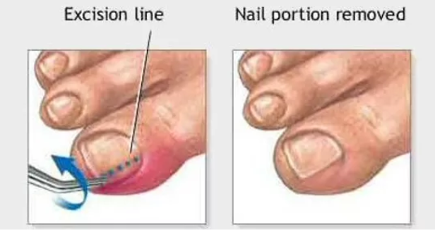 Ingrown Toenail Removal Treatment - Toronto Laser Nail