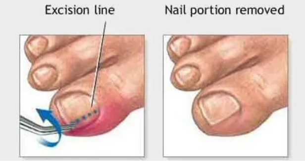 http://www.lasernailtoronto.com/wp-content/uploads/2021/09/Ingrown-Toenail-procedure.png